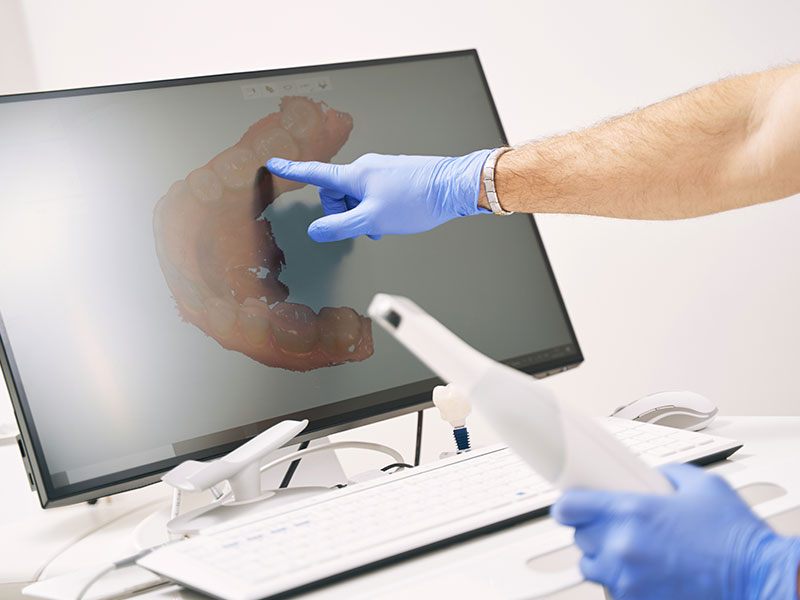 Scanner orale 3D