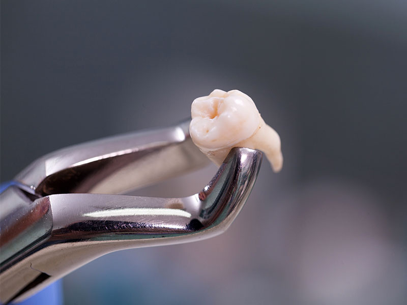 Chirurgia orale estrazione dente